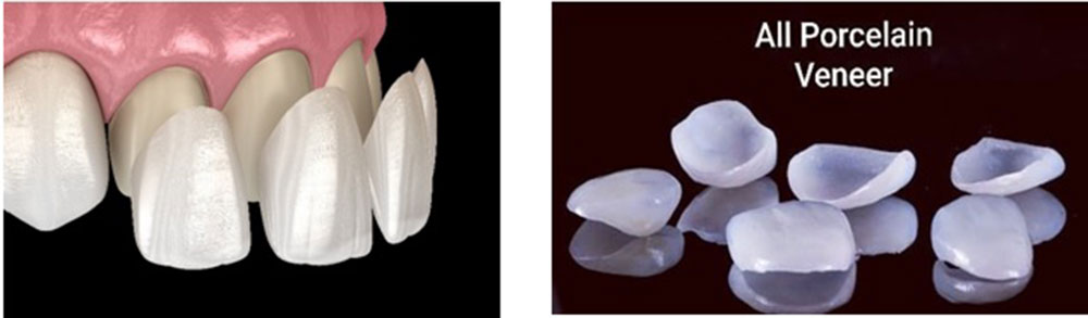 Dental veneers 
