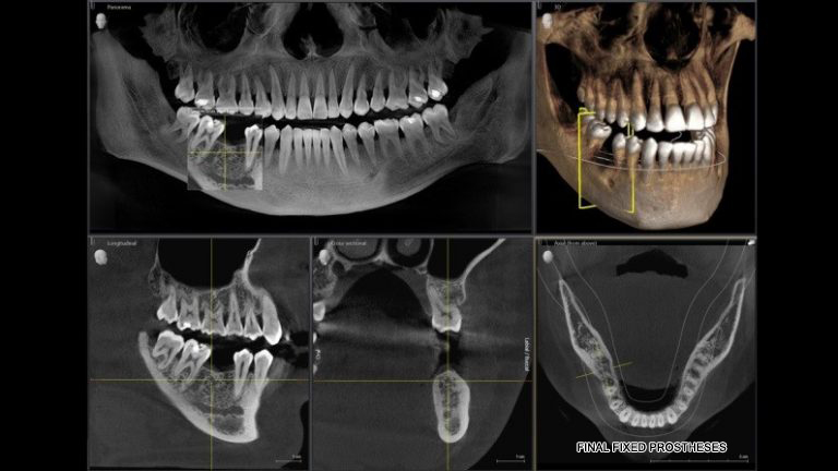 Dental CT Scan