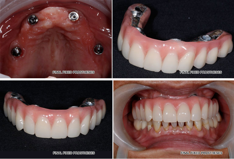 Dental Implants