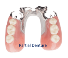 Partial denture