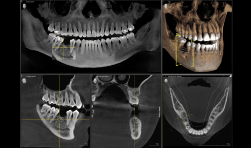 Root Canal Treatment 3