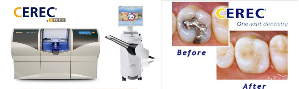 CEREC 3D 1