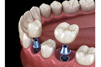 single tooth dental implant