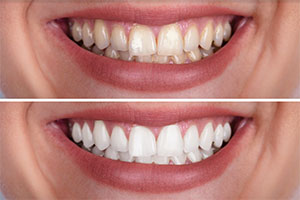 teeth whitening in Phuket