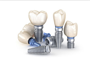 Dental Implant