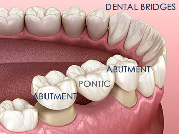 Dental Bridges
