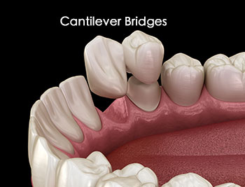 Cantilever Bridges