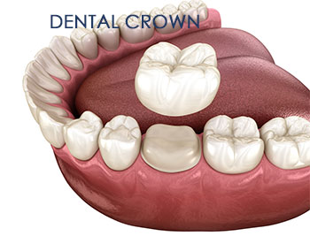 Dental Crown