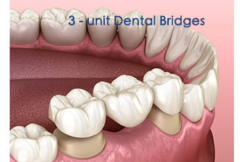 DENTURES 2