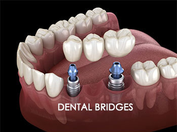 Dental Implant Bridges