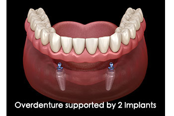 DENTURES 3