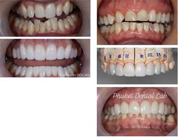 Dental Veneers Phuket 1